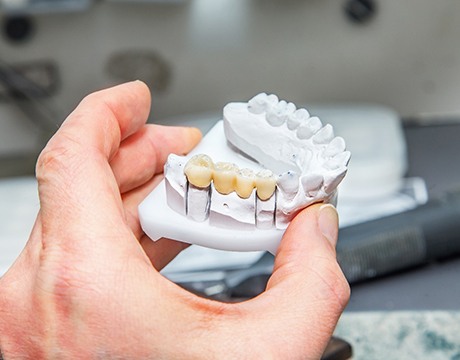 Dental bridge in Gainesville on clay model