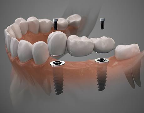 Digital illustration of implant dental bridge in Gainesville