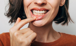 a woman showing signs of gum recession