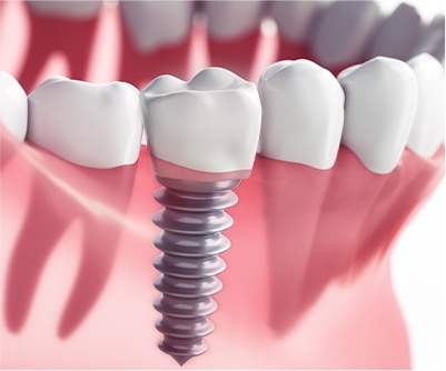 Dental implant special coupon