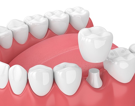 Illustration of dental crown being placed on tooth