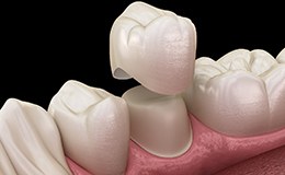 Render of row of teeth and dental crown in Gainesville, GA
