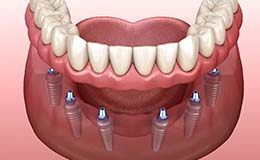 Diagram of implant dentures in Gainesville