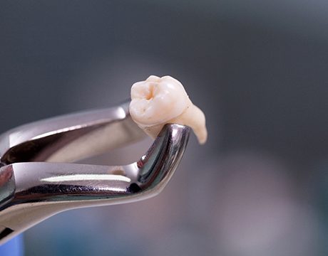 Forceps holding extracted tooth in Gainesville