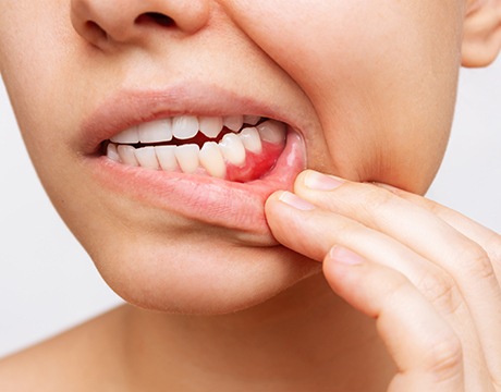 a woman pulling her lip down to reveal an inflamed gumline