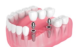Diagram of dental implants in Gainesville and their components
