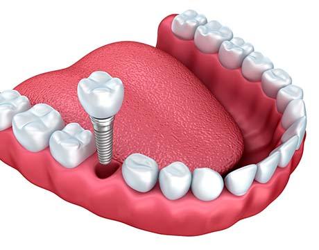 model of how dental implants in Gainesville work