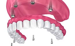 model of four dental implants supporting a full denture