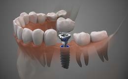 model of a single dental implant with a crown