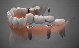 model of two dental implants with a bridge