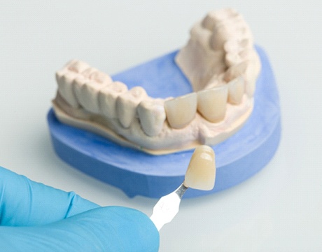 dentist holding a porcelain veneer