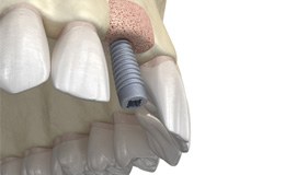 Digital illustration of bone graft