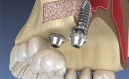 a person practicing talking with dentures