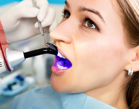 woman getting tooth-colored filling cured with UV light