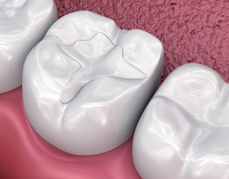 diagram of tooth-colored filling