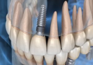 Model of dental implants