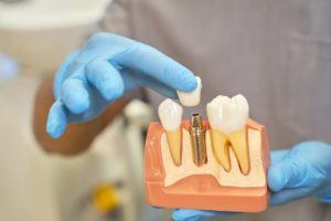 dentist holding a model of a dental implant