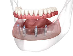 an illustration of all-on-4 dental implants
