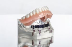 Model of implant-supported denture