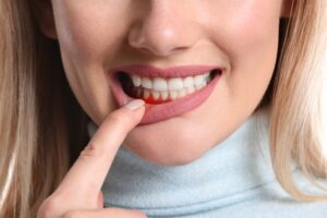 person lowering their lip to reveal an inflamed gumline