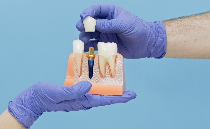 Hands holding model dental implant