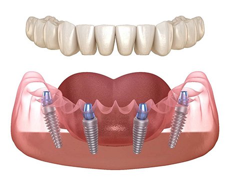 Illustration of All-on-4 in Gainesville, GA for the lower jaw