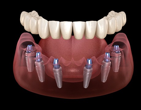 Illustration of implant dentures in Gainesville against dark background