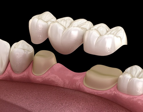 Diagram of a dental bridge in Gainesville over modified teeth